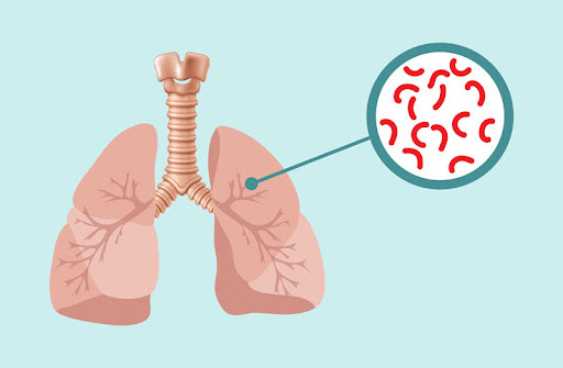 Ban hành Chiến lược quốc gia phòng, chống bệnh Lao cho giai đoạn mới