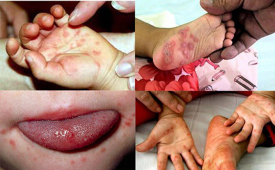 Bệnh tay, chân, miệng gia tăng nhanh, có nguy cơ bùng phát thành dịch
