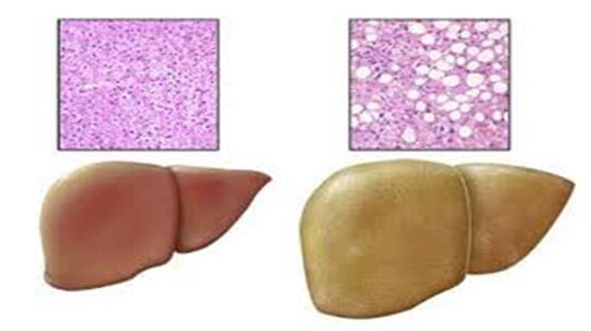 Gan nhiễm mỡ không do rượu - Nên tầm soát sớm