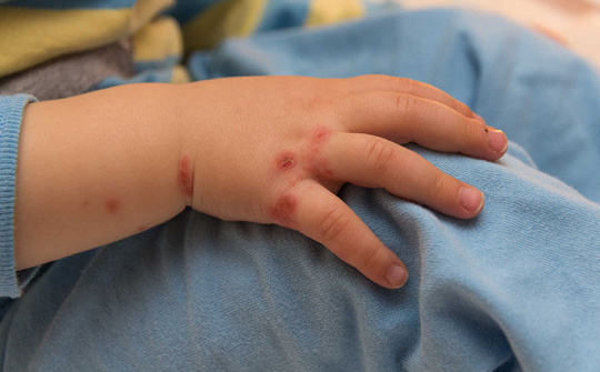 Xuất hiện 10 ca mắc tay chân miệng do nhiễm khuẩn EV71 tại Hà Nội