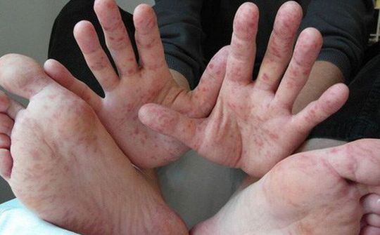 Chuyên gia chỉ cách phân biệt bệnh tay chân miệng với các bệnh khác?