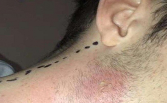 Nam sinh 17 tuổi suýt mất mạng vì nặn mụn