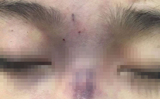 Thêm một bệnh nhân bị mù do tiêm filler nâng mũi