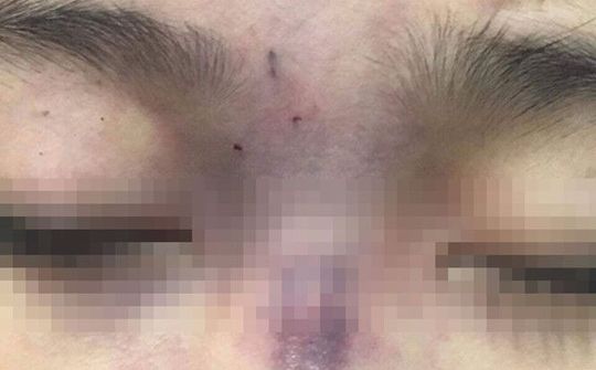 Thêm một bệnh nhân bị mù do tiêm filler nâng mũi