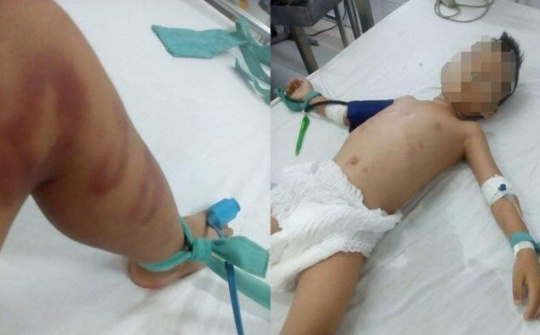 Thừa Thiên-Huế: Bé trai 6 tuổi bị bạo hành, nhập viện trong tình trạng nguy kịch