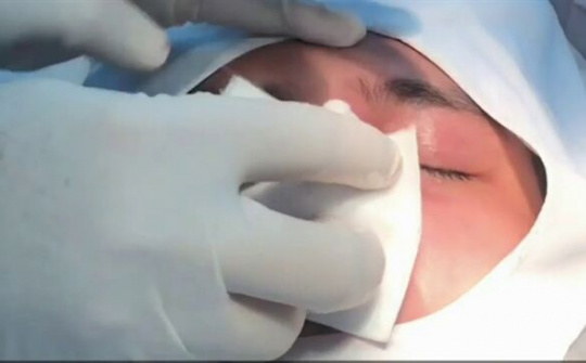 Tiêm filler nâng mũi, nữ sinh 20 tuổi nguy cơ bị mù mắt