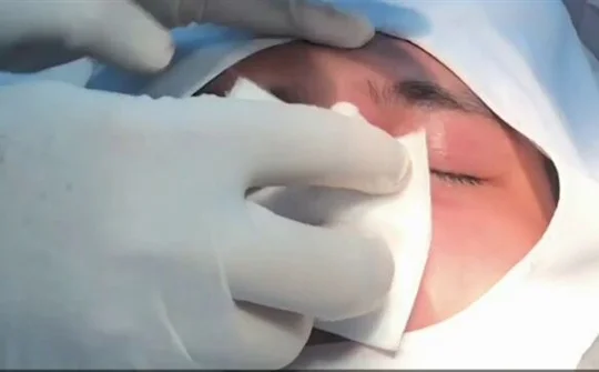 Tiêm filler nâng mũi, nữ sinh 20 tuổi nguy cơ bị mù mắt
