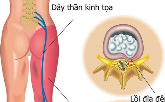 Khi nào tê nhức chân tay là bệnh lý?
