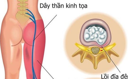 Khi nào tê nhức chân tay là bệnh lý?