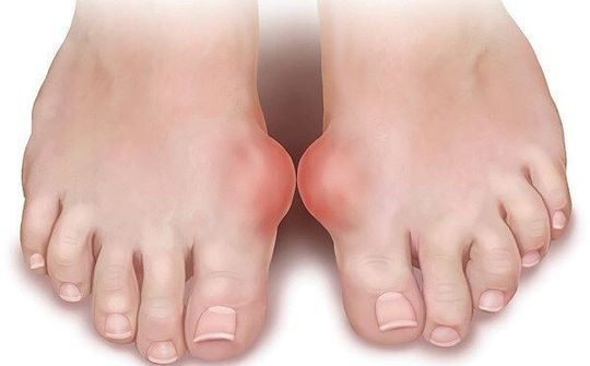 Thực phẩm ngày Tết 'đại kỵ' với người mắc bệnh gout