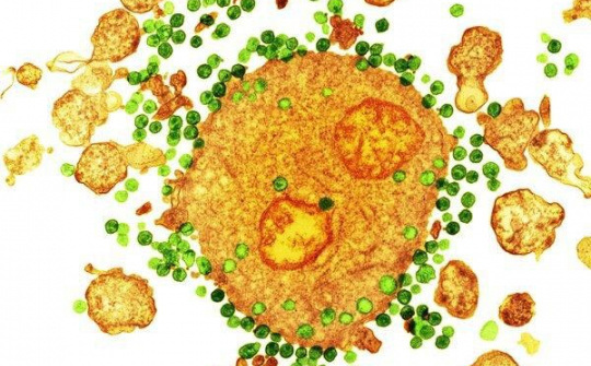 Bệnh nhân thứ 2 trên thế giới chữa khỏi HIV nhờ ghép tủy