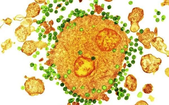 Bệnh nhân thứ 2 trên thế giới chữa khỏi HIV nhờ ghép tủy