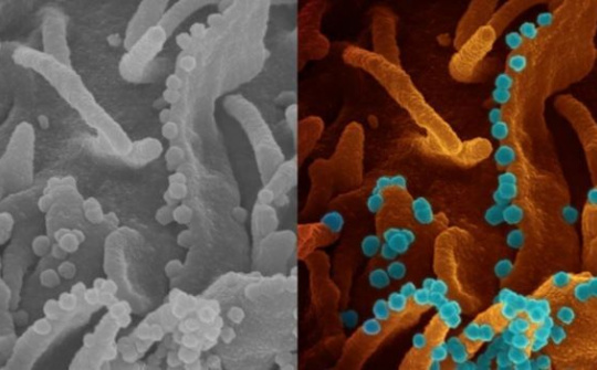 Hình ảnh tế bào virus SARS-CoV-2 sắp chết giải phóng các hạt virus mới