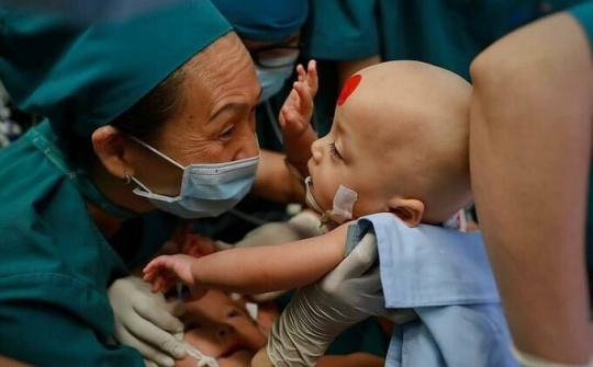 Đại phẫu thuật thành công tách rời cặp đôi song sinh dính nhau