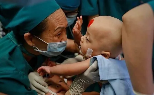 Đại phẫu thuật thành công tách rời cặp đôi song sinh dính nhau