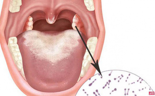 Đã có 20 trường hợp mắc bạch hầu, Bộ Y tế yêu cầu tăng cường phòng, chống