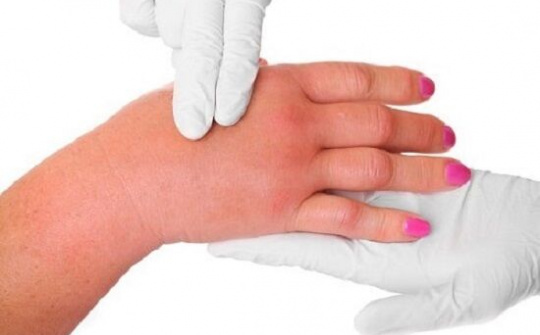 Viêm khớp dạng thấp là gì? Tại sao cần nhiều phương pháp điều trị?