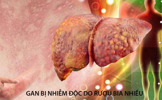 Thực phẩm bảo vệ sức khỏe BTAGAN - Hỗ trợ thanh nhiệt, giải độc gan hiệu quả
