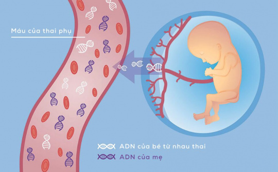 NIPT - Xét nghiệm sàng lọc trước sinh không xấm lấn