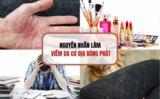 Eczestop - Giải pháp từ thiên nhiên hiệu quả cải thiện viêm da cơ địa