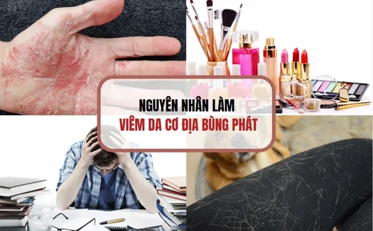 Eczestop - Giải pháp từ thiên nhiên hiệu quả cải thiện viêm da cơ địa