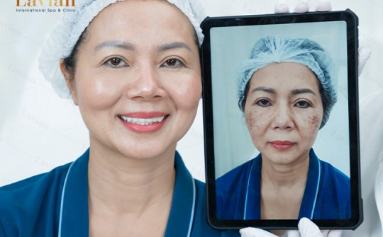 Picoway - Công nghệ vàng trong các giải pháp trị nám, độc quyền tại Viện thẩm mỹ Lavian