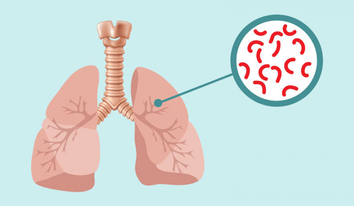 Tăng cường công tác phòng, chống bệnh Lao