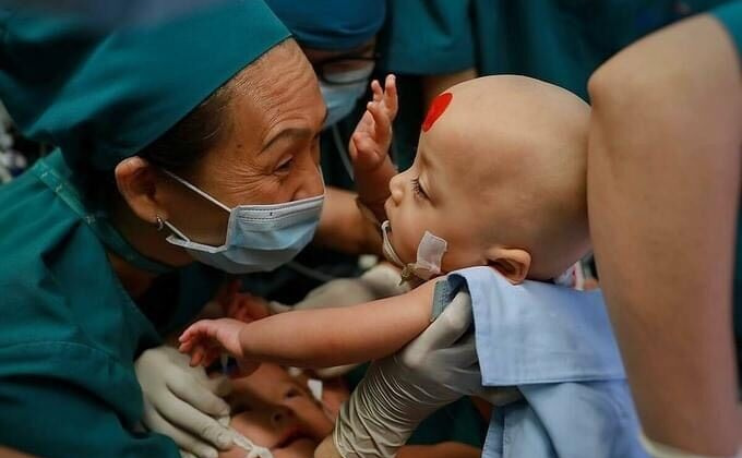 Đại phẫu thuật thành công tách rời cặp đôi song sinh dính nhau