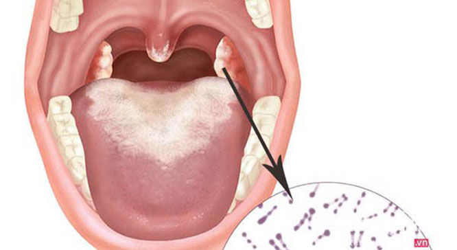 Đã có 20 trường hợp mắc bạch hầu, Bộ Y tế yêu cầu tăng cường phòng, chống