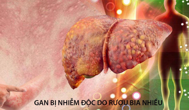 Thực phẩm bảo vệ sức khỏe BTAGAN - Hỗ trợ thanh nhiệt, giải độc gan hiệu quả