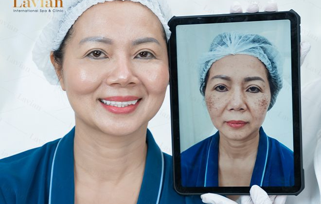 Picoway - Công nghệ vàng trong các giải pháp trị nám, độc quyền tại Viện thẩm mỹ Lavian