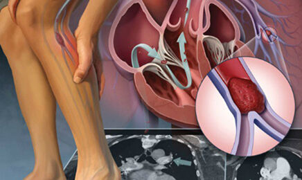 Suy giãn tĩnh mạch