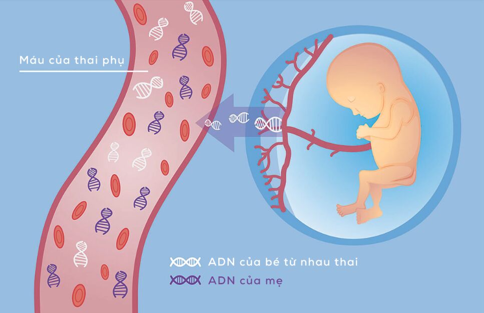 NIPT - Xét nghiệm sàng lọc trước sinh không xấm lấn